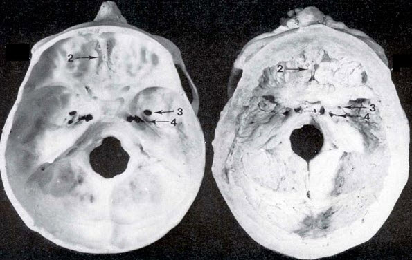 Marble bone disease
